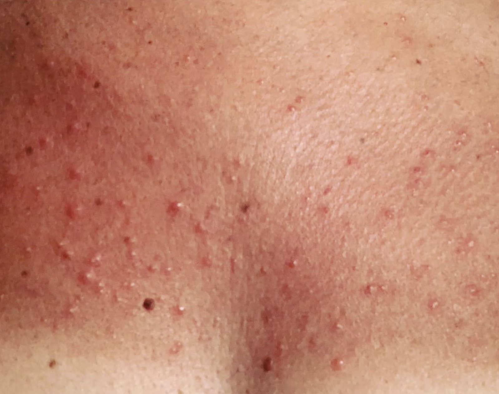 Featured image for the article Sun Allergy